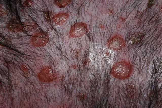 Lymphome cutané Lymphome cutané