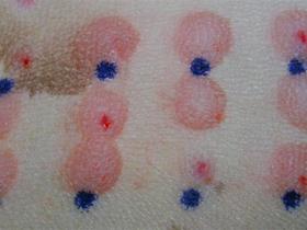 Intradermal test - Dermatologie: Allergieën