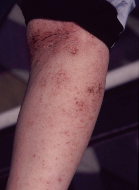 Dermato-zoonoses - L'animal responsable de maladie de la peau de l ...