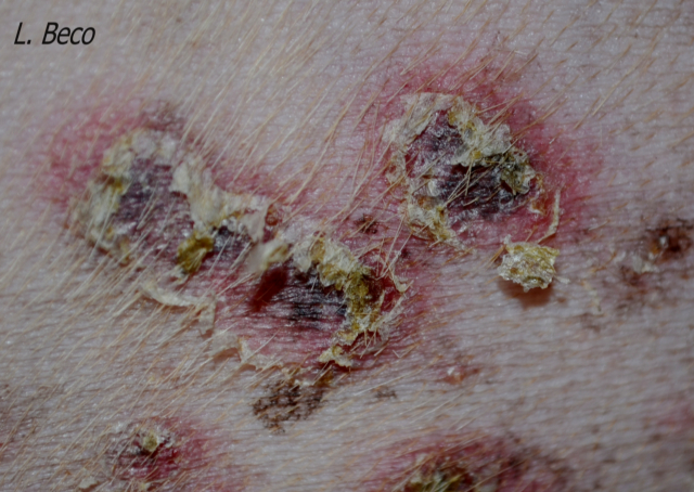 What Is MRSA?, Staph Infections