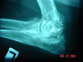 Coude avec implants d'Or - Goldtreat - Implants d'Or pour traiter l'arthrose