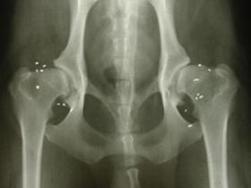 Radiograph of the hips with gold implants