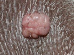 Sebaceous adenoma (benign tumour)