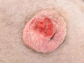 Mastocytome légèrement ulcéré au niveau mammaire