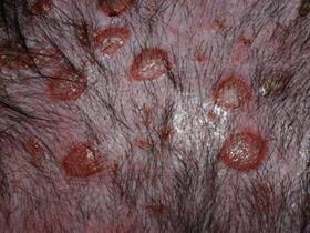 Cutaneous lymphoma - huidtumor