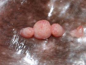 Oral papillomatosis (benign)