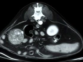Scanner d'une tumeur surrénalienne