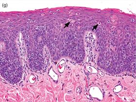 Mucosal epithelium contains apoptosis (arrows) at all mucosal epithelial levels