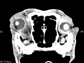 Tumeur (lymphome) rétrophtalmique