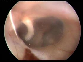 Normal tympanic membrane (Dog) (middle ear bone is seen through the tympanic membrane)