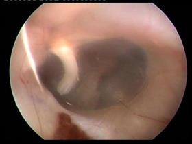 Normal tympanum of a dog (The maleus is visible through the tympanic membrane)