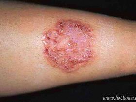 Infection humaine à dermatophyte / Tinea corporis (Image Université Iowa)