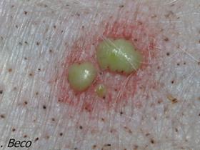 Pustule - Pyodermite - Infection bactérienne de la peau du chien