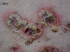 Bacterial cutaneous infection - MRSP