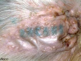 Dermatite pyogranulomateuse et lymphadénite juvénile stérile (cellulite juvénile): otite avec pustules sur le pavillon auriculaire