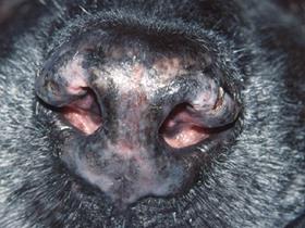 Cutaneous lupus erythematosus localized - Discoid Lupus