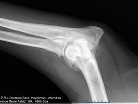 Severe osteoarthritis of the left elbow