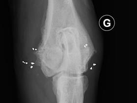 Implants Goldtreat® - Implants Gold Treat pour la gestion de certains cas d'arthrose